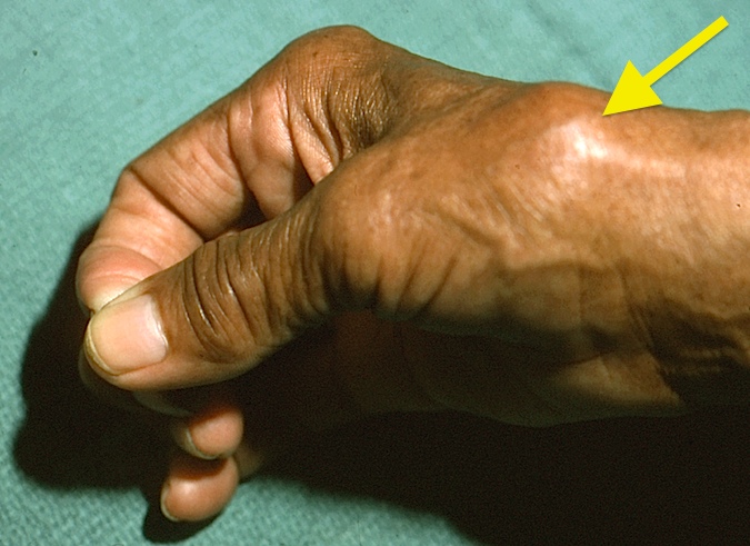 Osteoarthritis Carpometacarpal Cmc Joint Of Thumb Hand Surgery Resource 4016